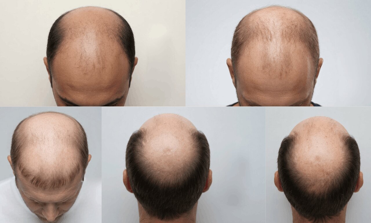 Before using Kickland Minoxidil 5% Treatment